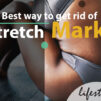 Stretch Marks Feature Image